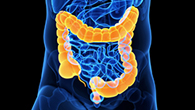 Darmkrebs - Aktuelles von der Vorsorge bis zur Therapie
